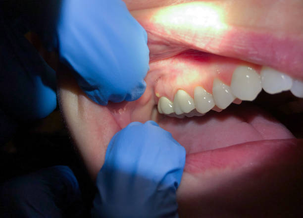 Best Emergency Tooth Extraction in White Hall, IL